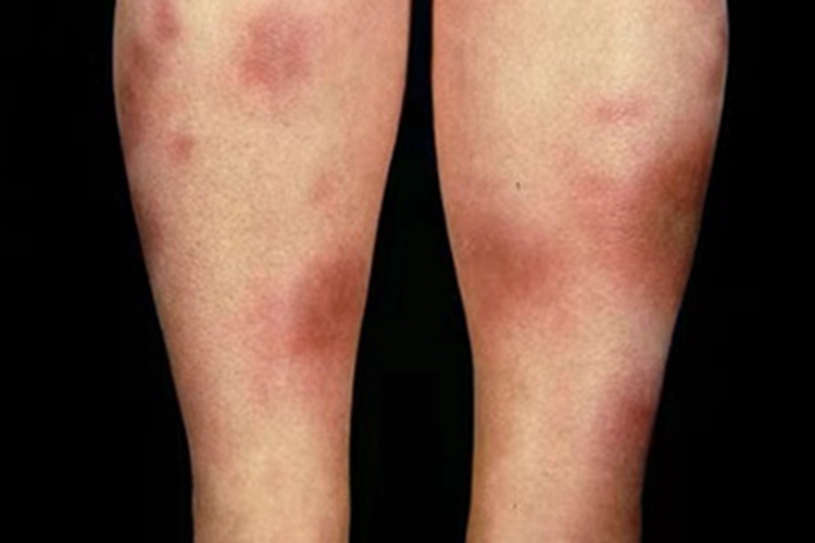 慢性期硬化性脂膜炎红斑图 慢性期硬化性脂膜炎红斑图