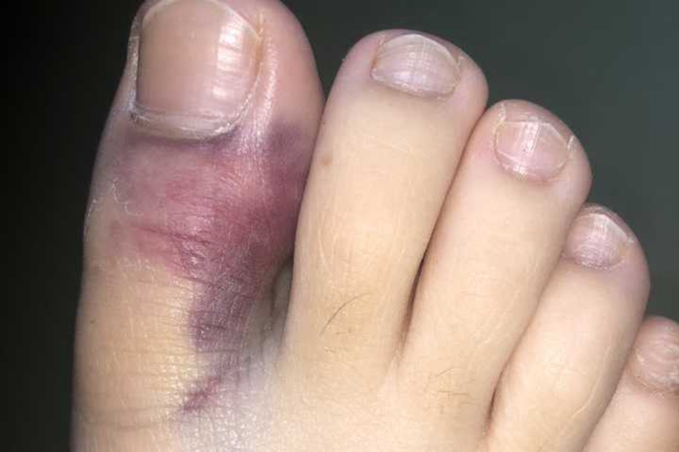 软组织损伤局部淤血图