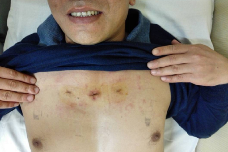 甲状腺腔镜手术胸骨切迹径路图