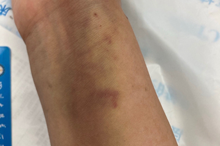 扭伤手腕皮肤发紫图 扭伤手腕皮肤发紫图