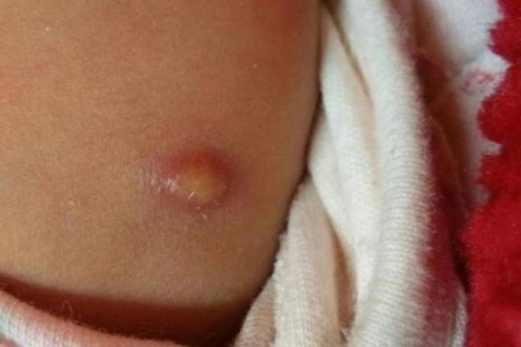 卡介苗接种后化脓图