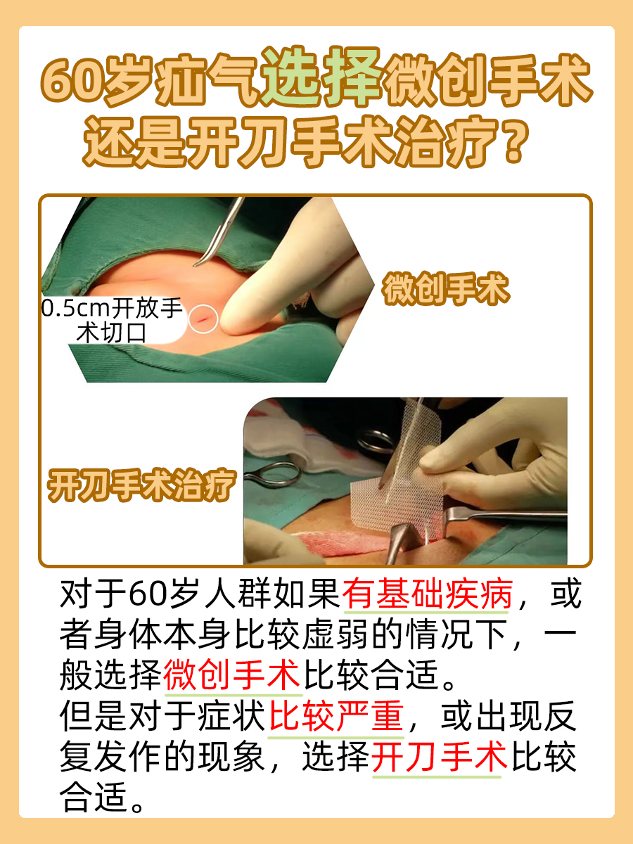 60岁疝气治疗微创VS传统开刀，贴心建议