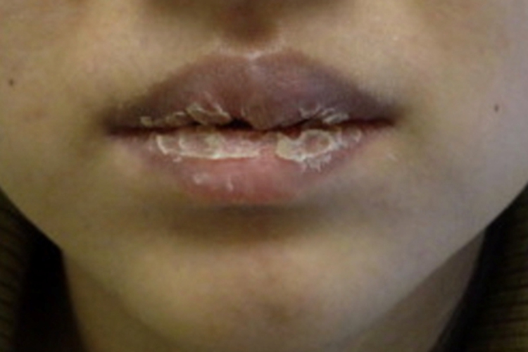 剥脱性唇炎嘴唇脱屑图