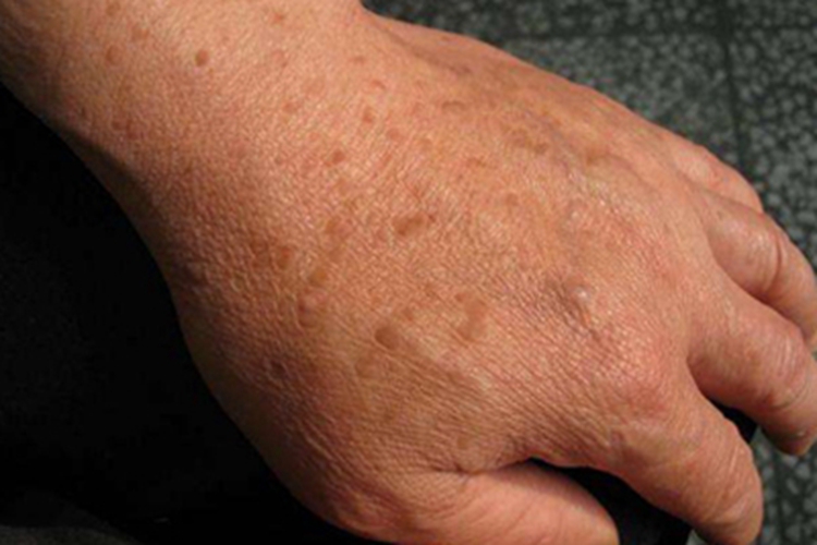 持久性豆状角化过度病手背斑点图