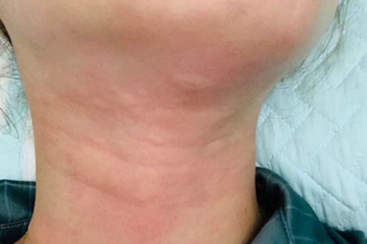 皮肤过敏红肿前颈症状图