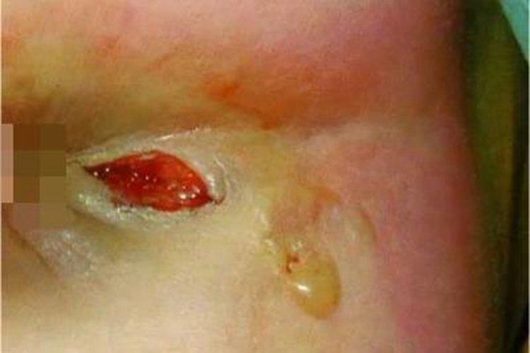 肛瘘肛周渗液图