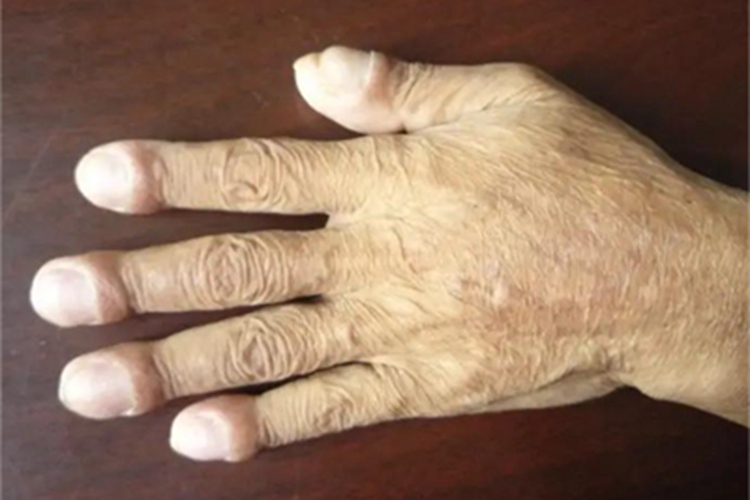 杵状指手指尖增厚图