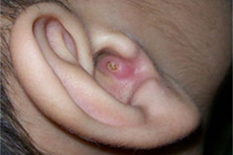 疖耳部症状图 疖耳部症状图