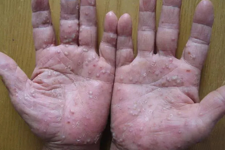 掌跖脓疱病图