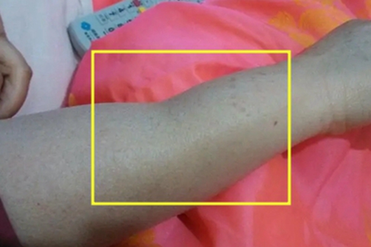 环状脂肪萎缩胳膊萎缩图