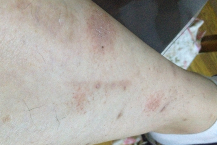 红斑狼疮腿上红斑有鳞屑图 红斑狼疮腿上红斑有鳞屑图