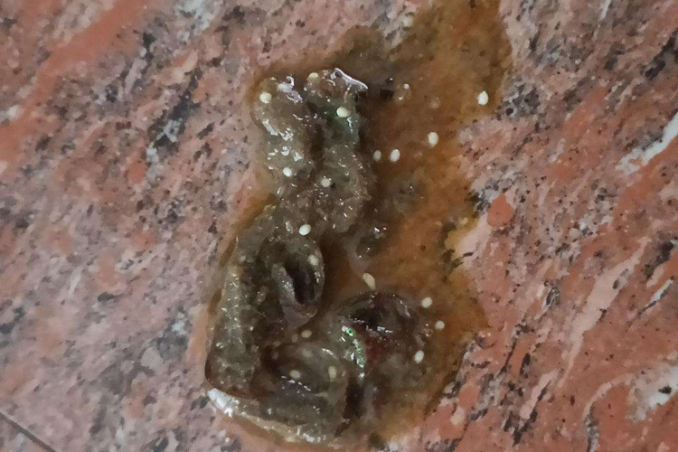 大便有白色芝麻状虫卵图