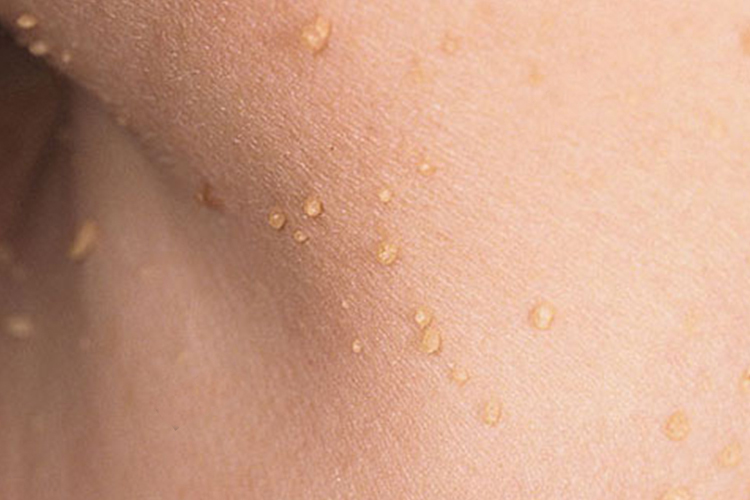 小丘疹型软纤维瘤图