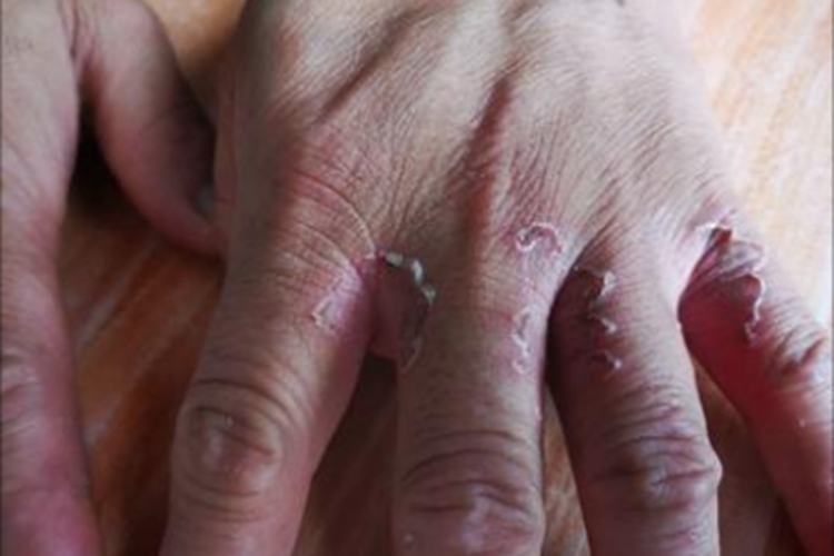 鳞屑角化型手癣手指缝症状图