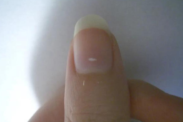 缺钙指甲白痕图