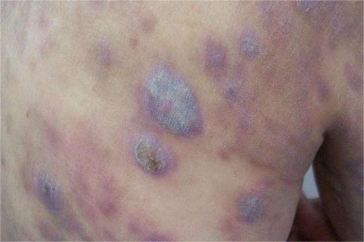 嗜酸性粒细胞增多性皮炎图 嗜酸性粒细胞增多性皮炎图