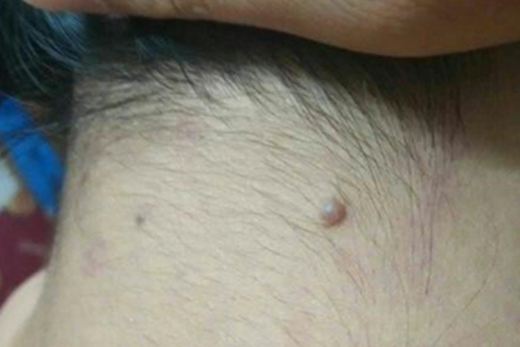 皮内痣脖子后面有疙瘩图 皮内痣脖子后面有疙瘩图
