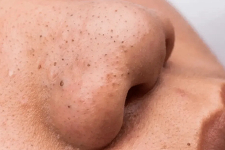 黑头粉刺痣鼻部症状图