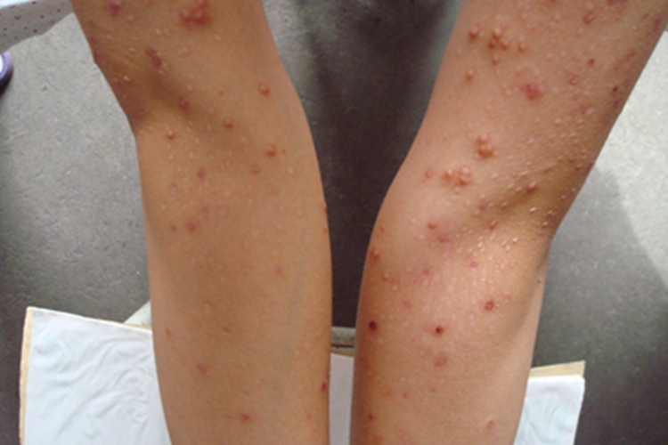 丘疹坏死性结核疹胳膊症状图