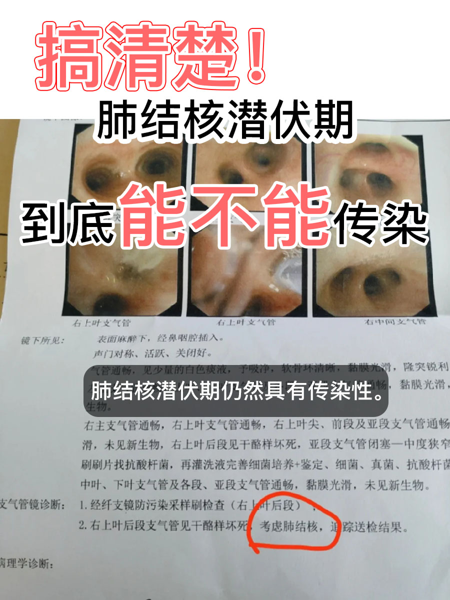 搞清楚！肺结核潜伏期到底能不能传染