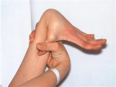 马方综合征大拇指向下弯曲紧贴手臂图.jpeg