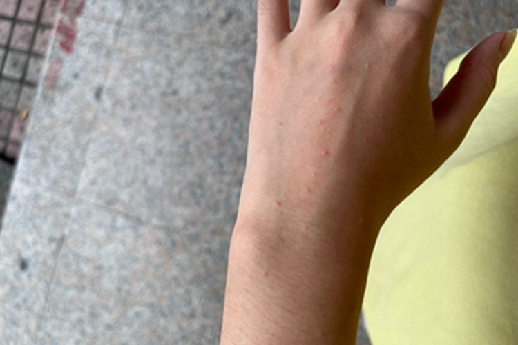 毛囊炎手背疙瘩图