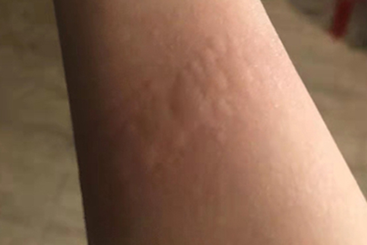 慢性自发性荨麻疹胳膊症状图