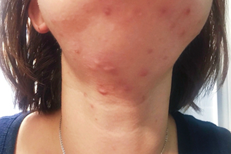 细菌性毛囊炎前颈症状图 细菌性毛囊炎前颈症状图