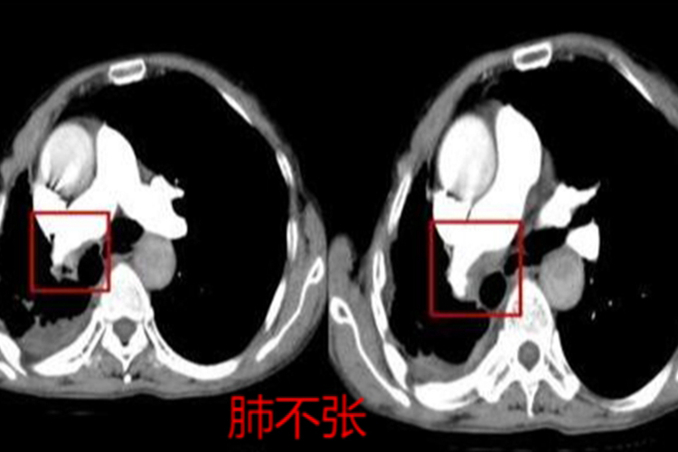 肺栓塞CT间接征象图