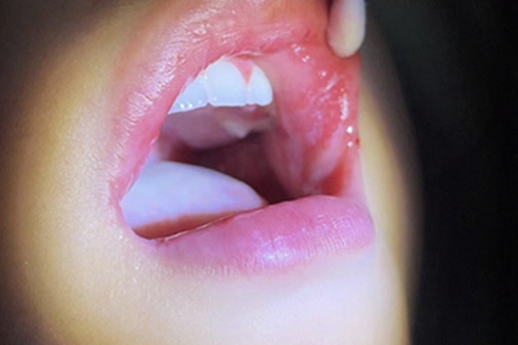 过敏性接触性口炎嘴唇水疱图