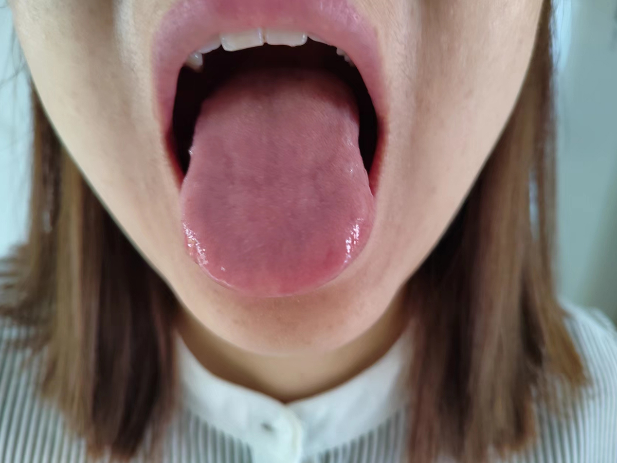 舌头是健康的一面镜子，裂纹舌、齿痕舌、胖大舌分别代表了什么？ - 哔哩哔哩