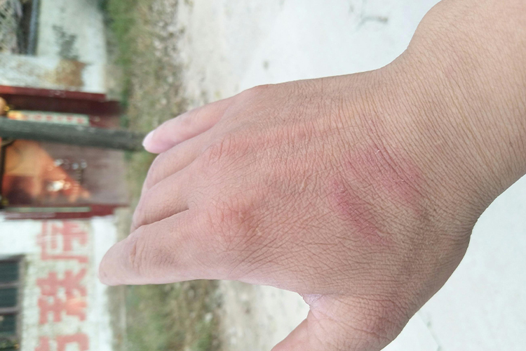 被葎草拉伤后图