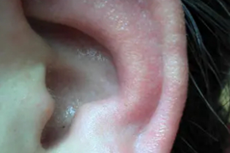 Ⅰ度冻伤耳廓又红又肿图