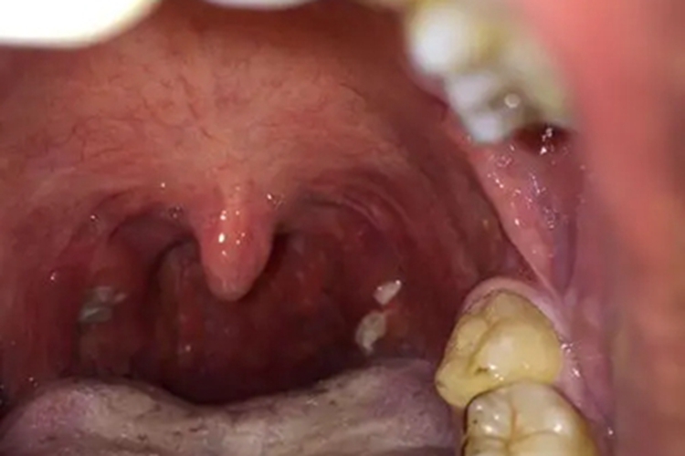 扁桃体角化症咽喉症状图