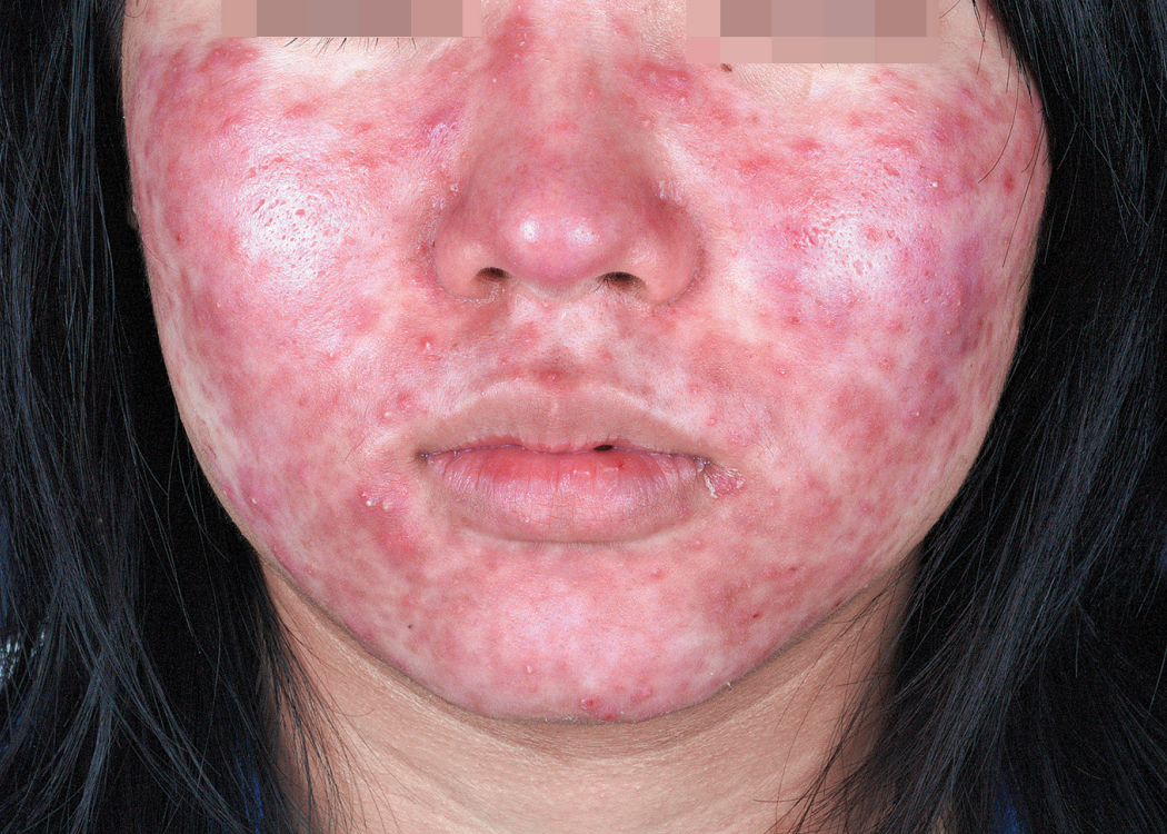 面部螨虫痘痘图 面部螨虫痘痘图