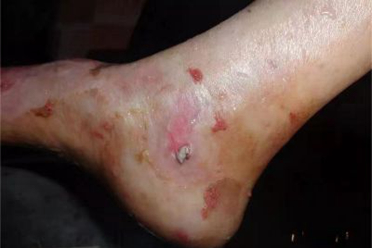 二度烫伤脚踝症状图 二度烫伤脚踝症状图