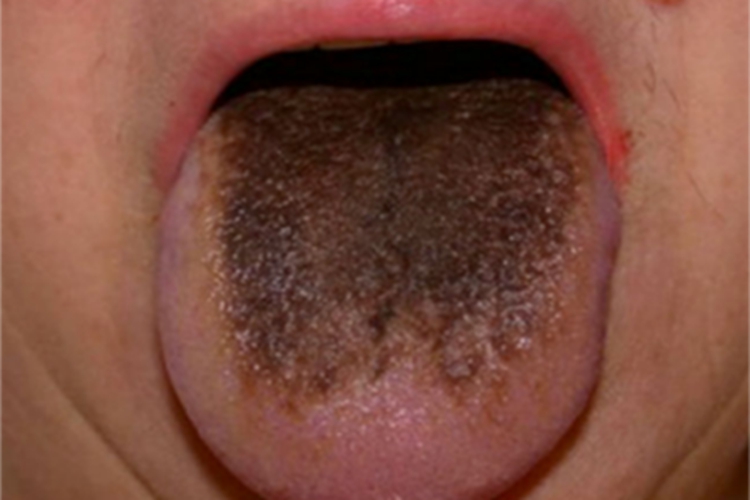 毛舌舌头中间黑了一片图