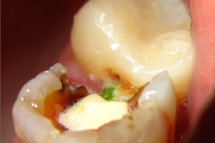 死髓牙牙齿坑图 死髓牙牙齿坑图