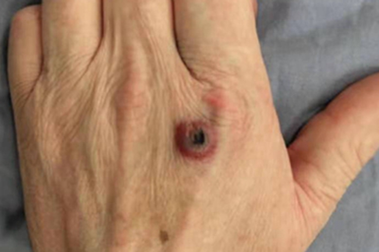 皮肤炭疽红肿图 皮肤炭疽红肿图