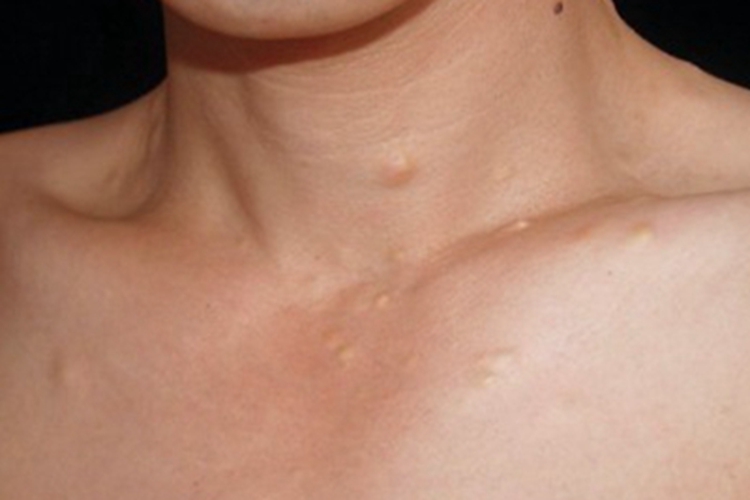 多发性脂囊瘤前颈包块图 多发性脂囊瘤前颈包块图