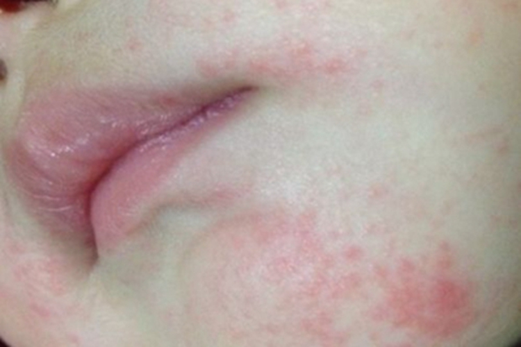 特应性皮炎口周丘疹图
