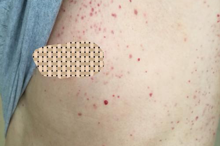 特发性血小板减少性紫癜图