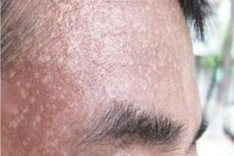 焦油黑变病白点图 焦油黑变病白点图