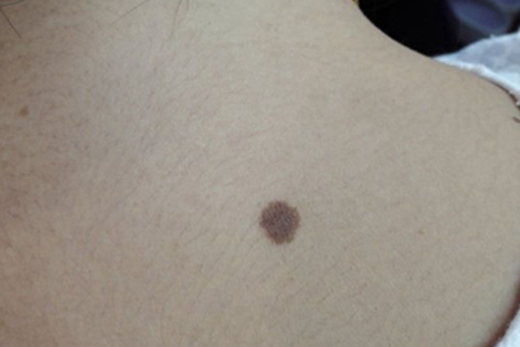 交界痣后背有褐色的痣图