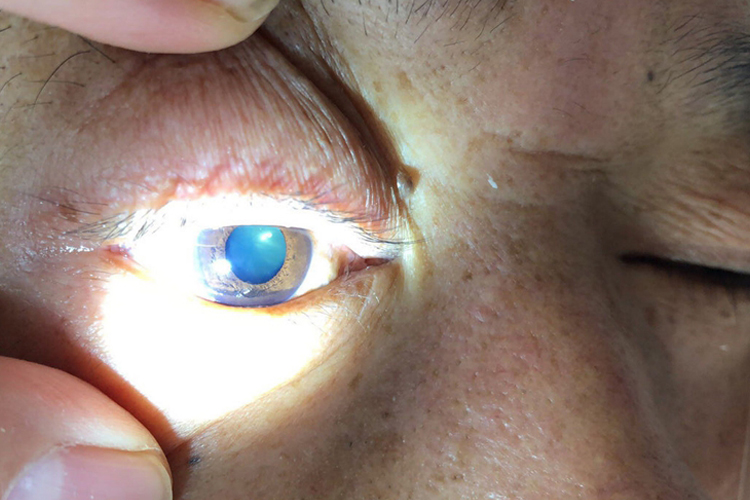 感染性休克瞳孔散大图 感染性休克瞳孔散大图