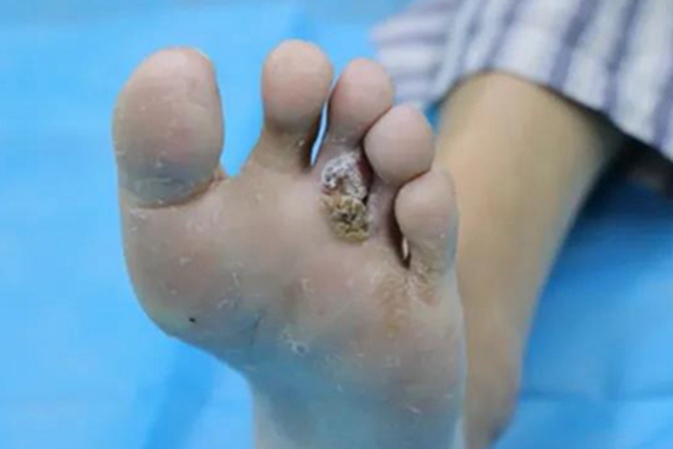 艾滋病期脚底症状图