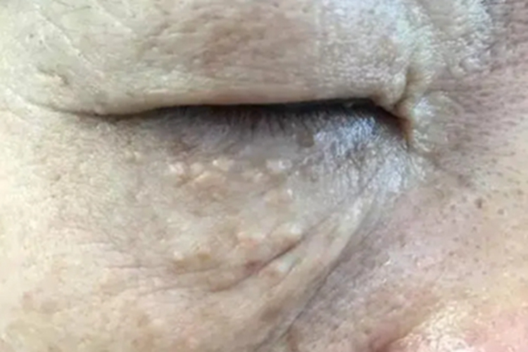 汗腺瘤眼睑淡黄色丘疹图 汗腺瘤眼睑淡黄色丘疹图