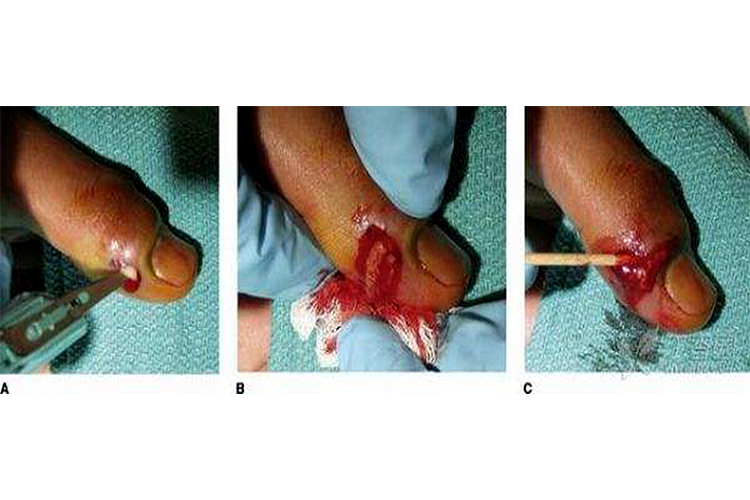 指头脓肿切开图