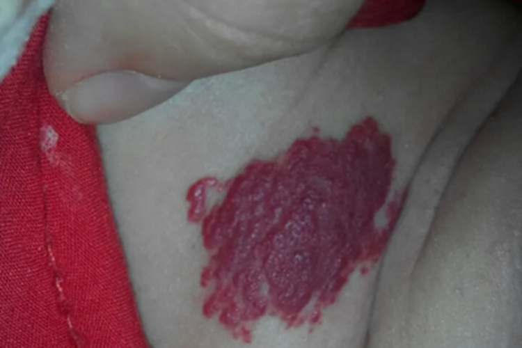 海绵状血管瘤胸部红斑图