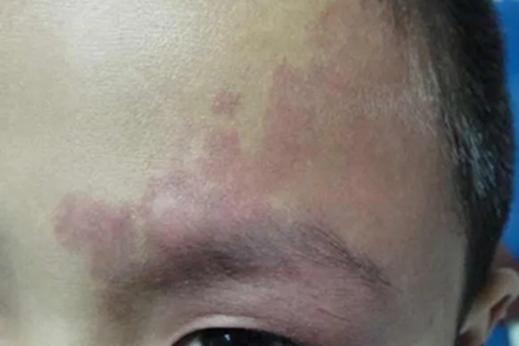 伊藤痣颞部有大面积红斑图